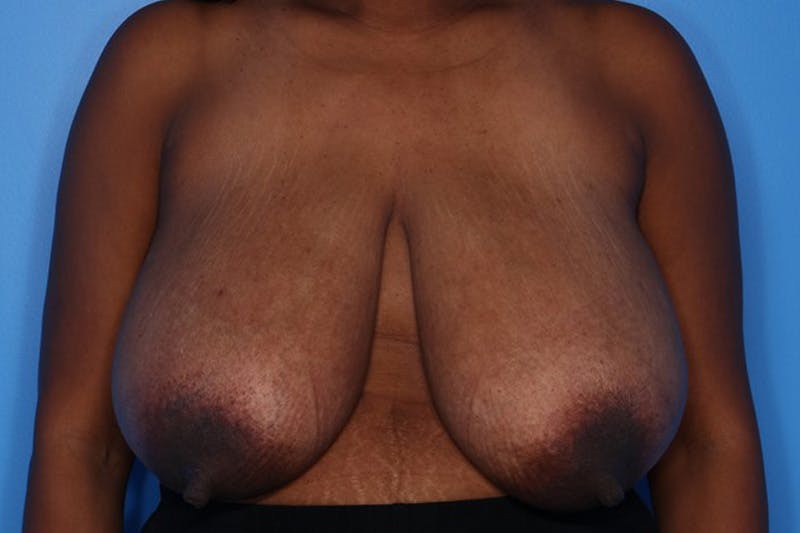 Breast Reduction Before & After Gallery - Patient 154776 - Image 1
