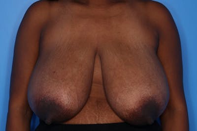 Breast Reduction Before & After Gallery - Patient 154776 - Image 1
