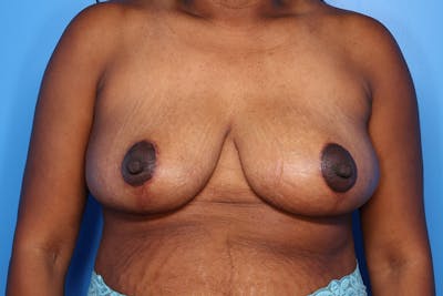 Breast Reduction Before & After Gallery - Patient 154776 - Image 2