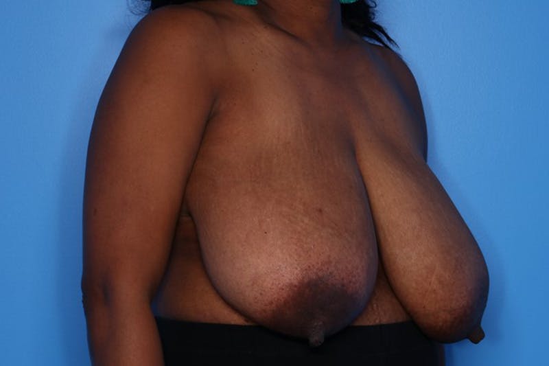 Breast Reduction Before & After Gallery - Patient 154776 - Image 3