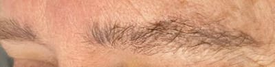 Eyebrow Microblading Before & After Gallery - Patient 254238 - Image 1
