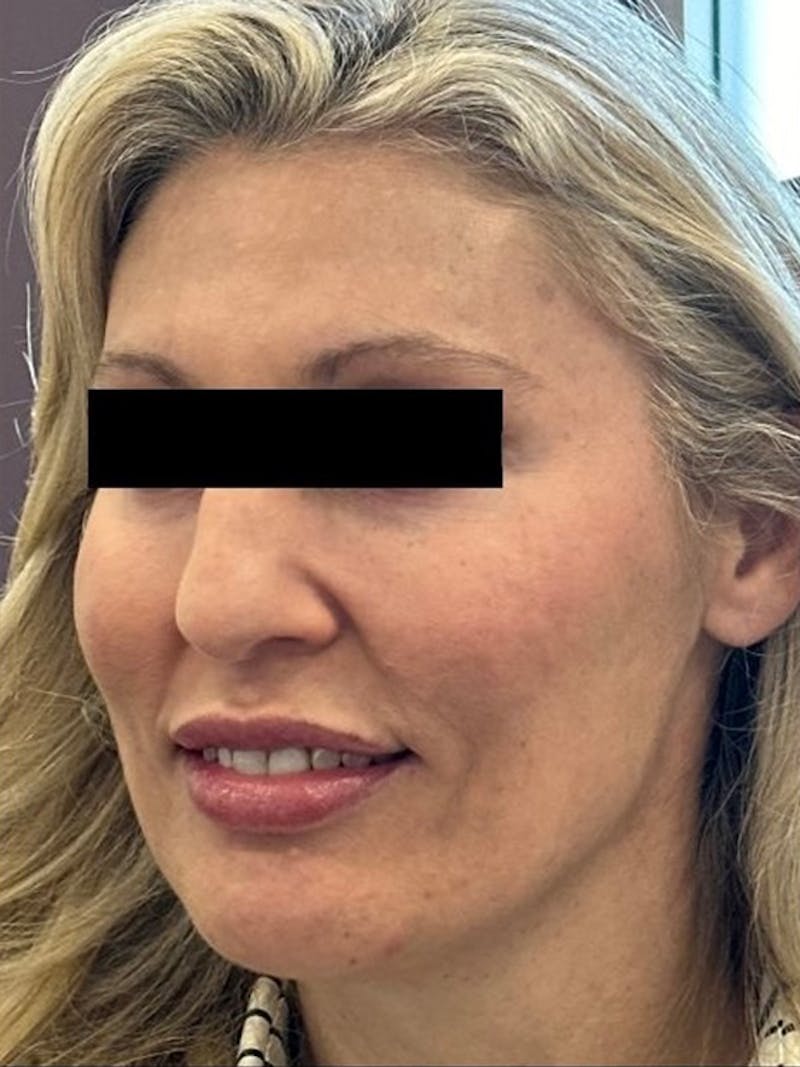 Chin Filler Before & After Gallery - Patient 109438 - Image 1