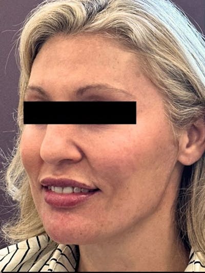 Chin Filler Before & After Gallery - Patient 109438 - Image 2