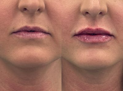 Lip Filler Before & After Gallery - Patient 358448 - Image 1