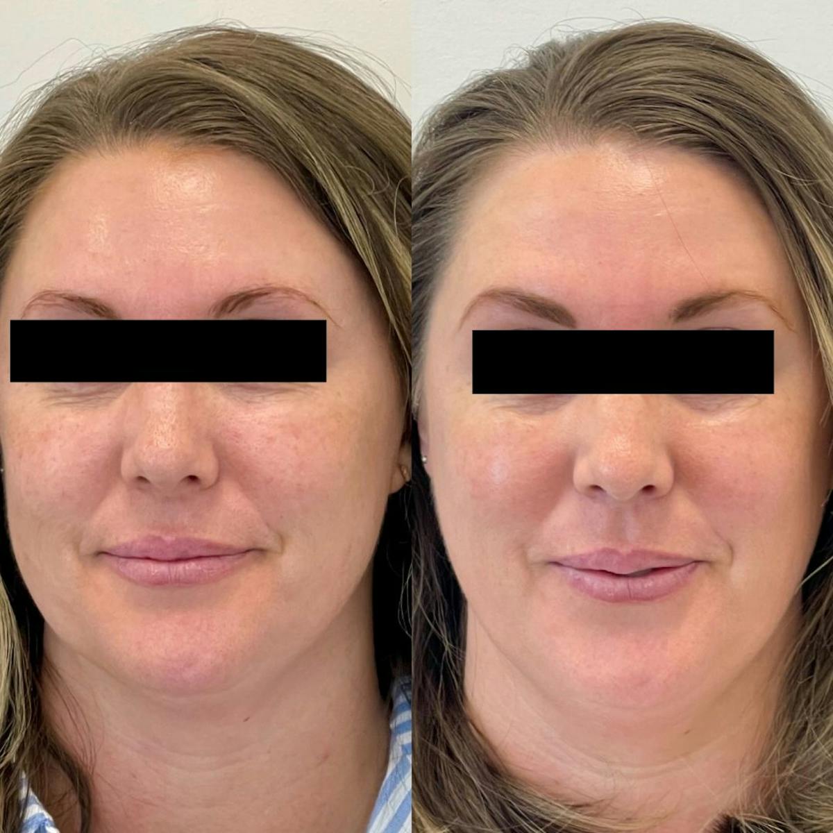 Clear + Brilliant® Before & After Gallery - Patient 229664 - Image 1