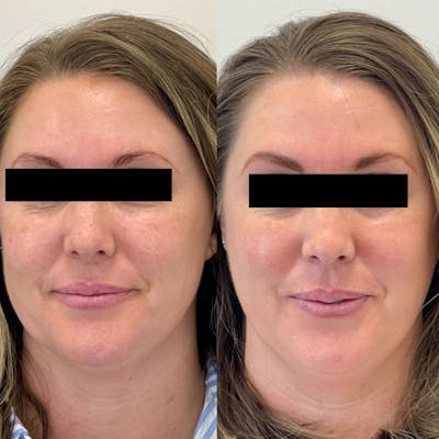 Clear + Brilliant® Before & After Gallery - Patient 229664 - Image 1