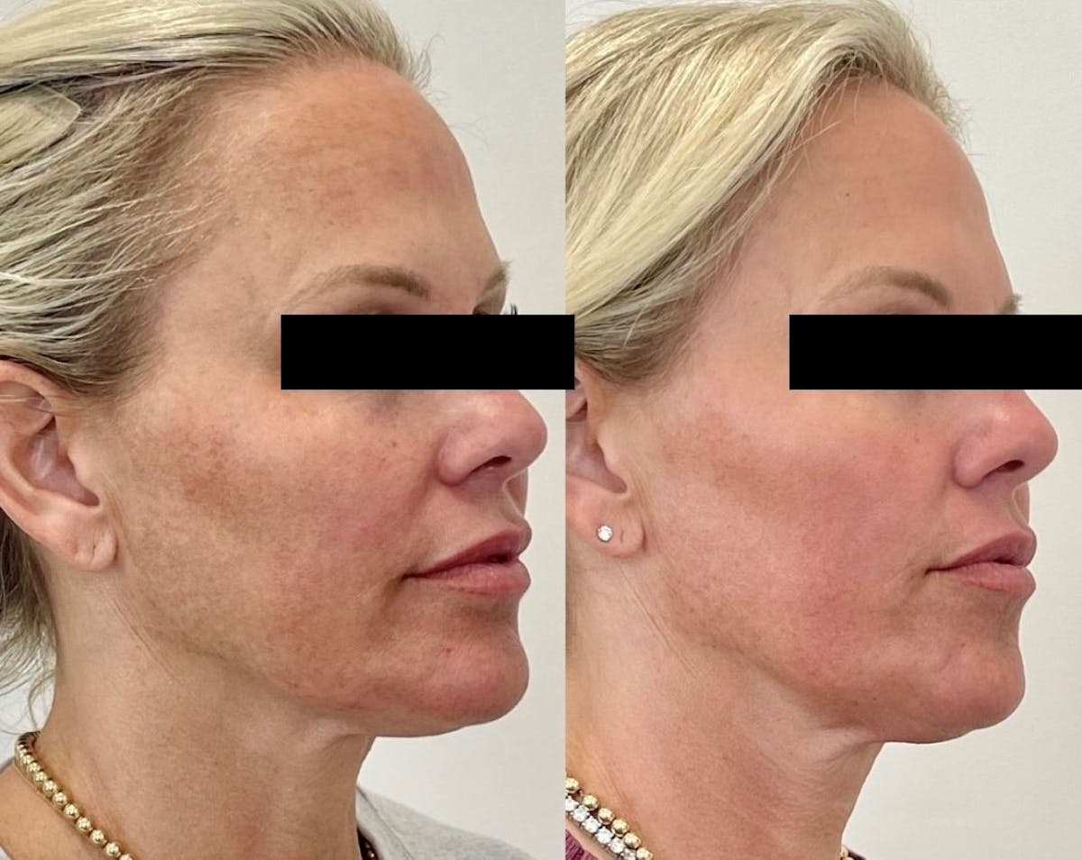 Sciton® Halo Before & After Gallery - Patient 314800 - Image 3
