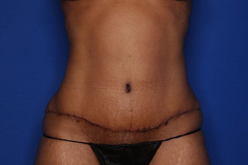 Tummy Tuck Before & After Gallery - Patient 396916 - Image 2
