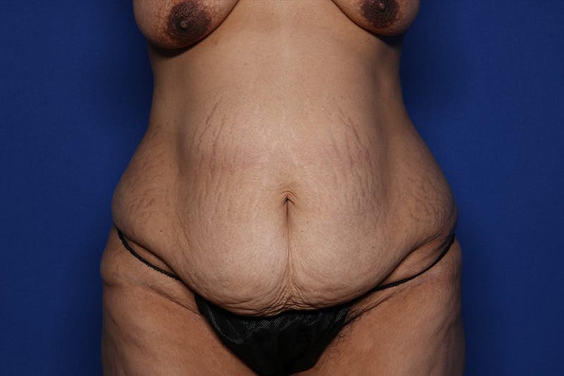 Tummy Tuck Before & After Gallery - Patient 418161 - Image 1