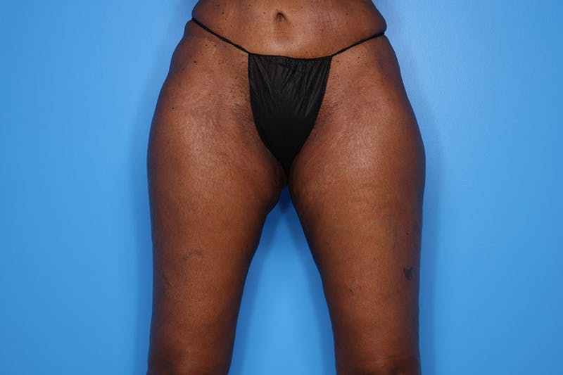 Thigh Lift Before & After Gallery - Patient 424363 - Image 2