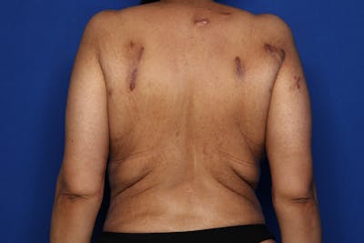 Bra Line Lift Before & After Gallery - Patient 175022 - Image 1