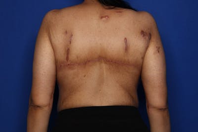 Bra Line Lift Before & After Gallery - Patient 175022 - Image 2