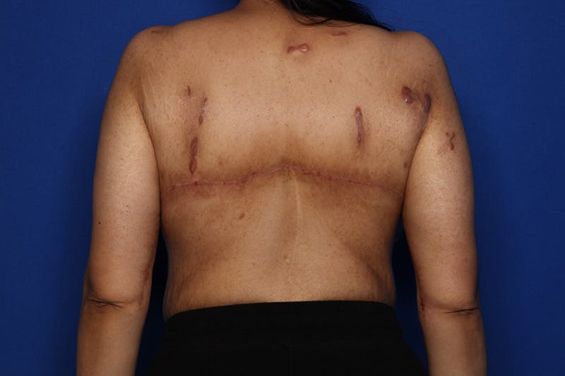 Bra Line Lift Before & After Gallery - Patient 175022 - Image 2