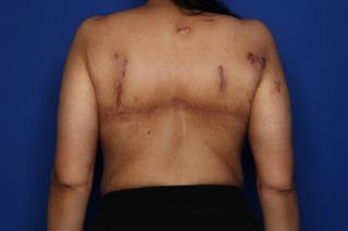 Bra Line Lift Before & After Gallery - Patient 175022 - Image 2