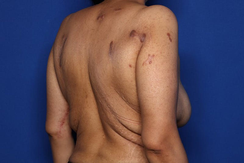 Bra Line Lift Before & After Gallery - Patient 175022 - Image 3