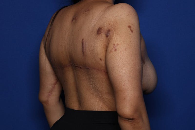 Bra Line Lift Before & After Gallery - Patient 175022 - Image 4