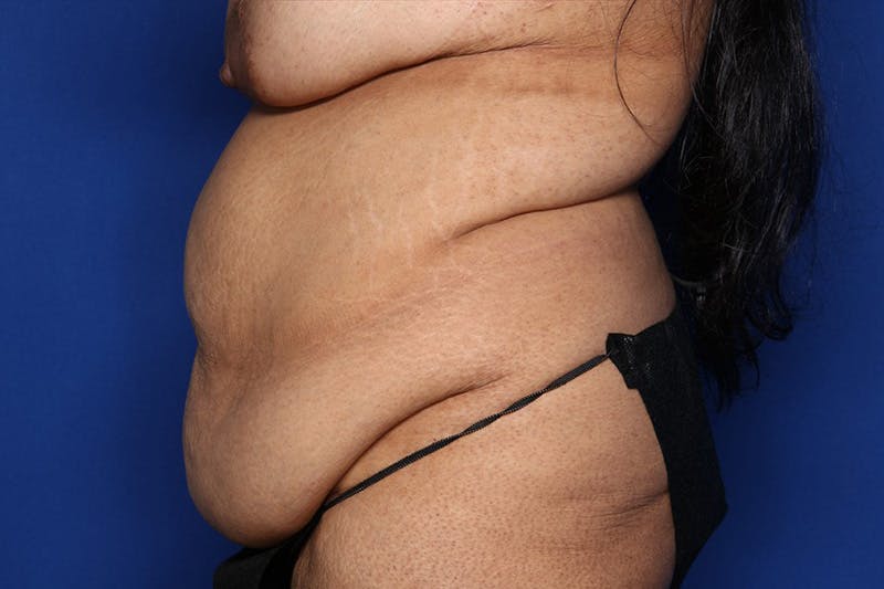 Tummy Tuck Before & After Gallery - Patient 243317 - Image 3