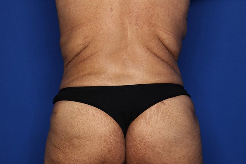 Tummy Tuck Before & After Gallery - Patient 243317 - Image 6