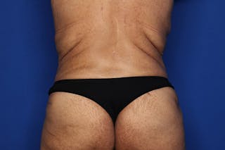 BodyTite™ Before and After Before & After Gallery - Patient 629582 - Image 6