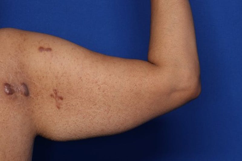 Arm Lift Before & After Gallery - Patient 349618 - Image 3