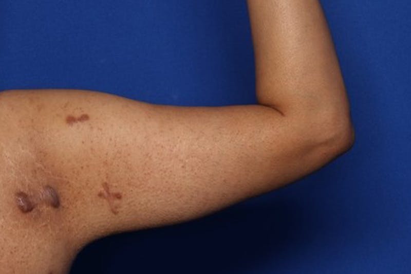 Arm Lift Before & After Gallery - Patient 349618 - Image 4
