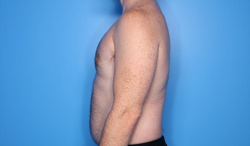 Gynecomastia (Male Breast Reduction) Before & After Gallery - Patient 389721 - Image 4