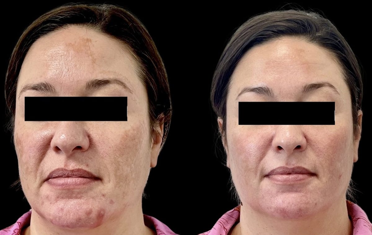Sciton® Halo Before & After Gallery - Patient 397916 - Image 1