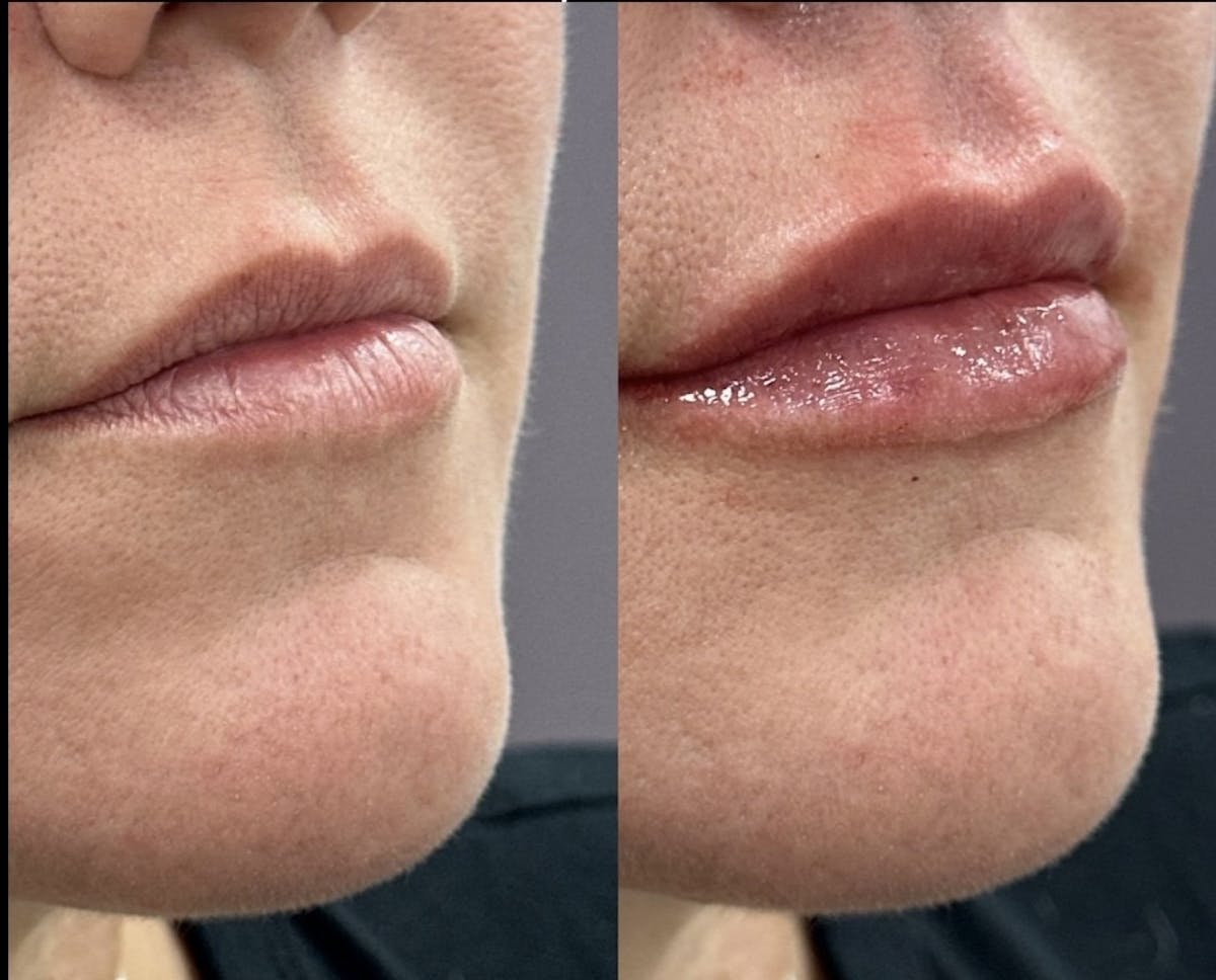Lip Filler Before & After Gallery - Patient 227678 - Image 1