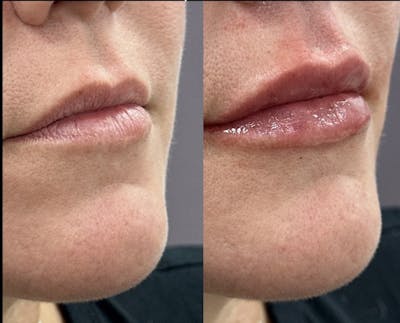 Lip Filler Before & After Gallery - Patient 227678 - Image 1