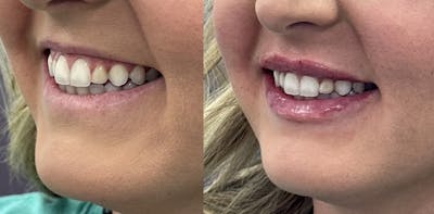 Lip Filler Before & After Gallery - Patient 422878 - Image 1