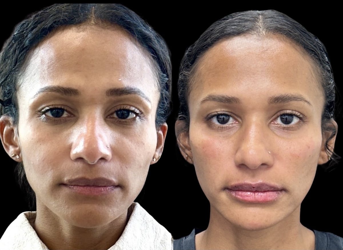 BOTOX Before & After Gallery - Patient 302506 - Image 1