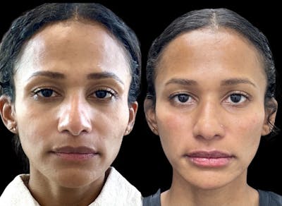 Lip Filler Before & After Gallery - Patient 386959 - Image 1
