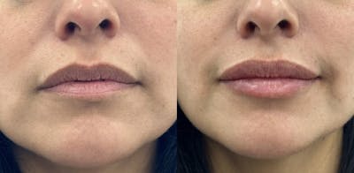 Lip Filler Before & After Gallery - Patient 428488 - Image 1