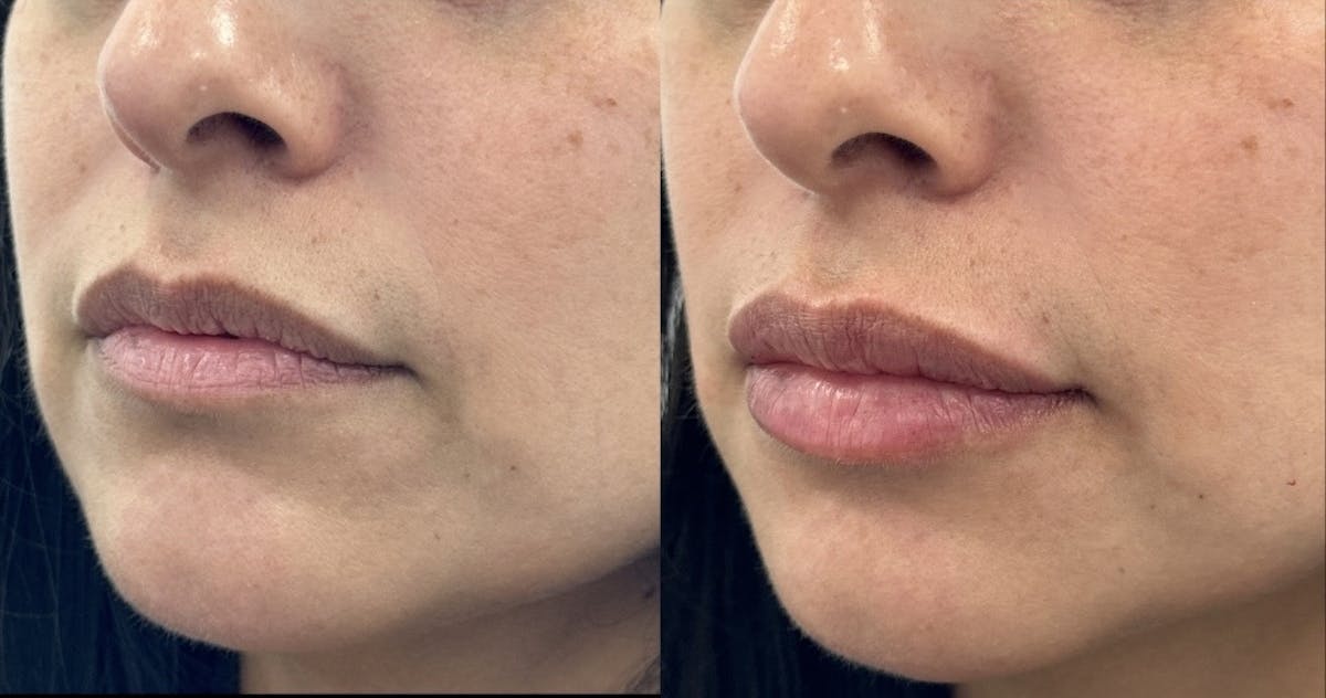 Lip Filler Before & After Gallery - Patient 428488 - Image 2