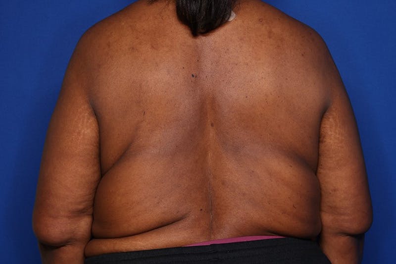 Body Lift Before & After Gallery - Patient 352837 - Image 5