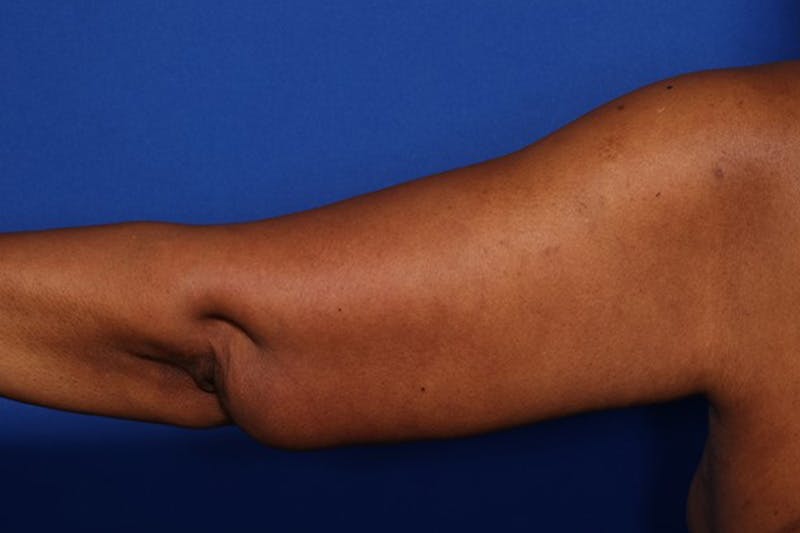 Body Lift Before & After Gallery - Patient 352837 - Image 10