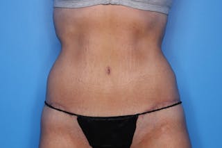 Body Lift Before & After Gallery - Patient 385536 - Image 2