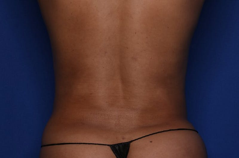 Liposuction Before & After Gallery - Patient 415365 - Image 6