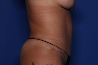 Tummy Tuck Before & After Gallery - Patient 195506 - Image 6
