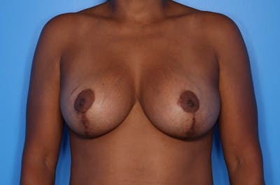Implant Exchange Before & After Gallery - Patient 189492 - Image 2