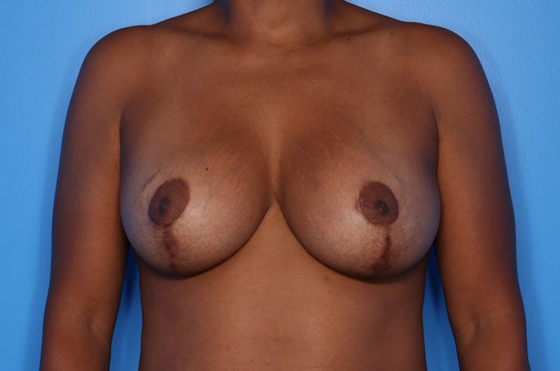 Implant Exchange Before & After Gallery - Patient 189492 - Image 2