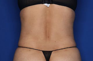 Tummy Tuck Before & After Gallery - Patient 674073 - Image 8