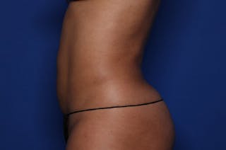 Liposuction Before & After Gallery - Patient 415365 - Image 4