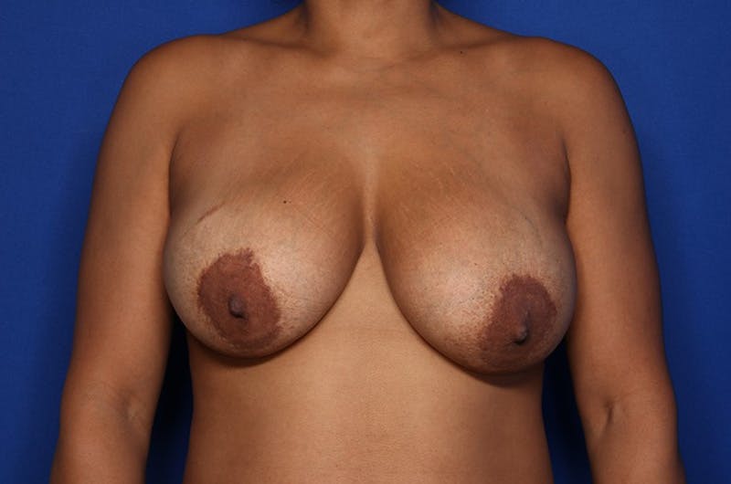 Implant Exchange Before & After Gallery - Patient 189492 - Image 1