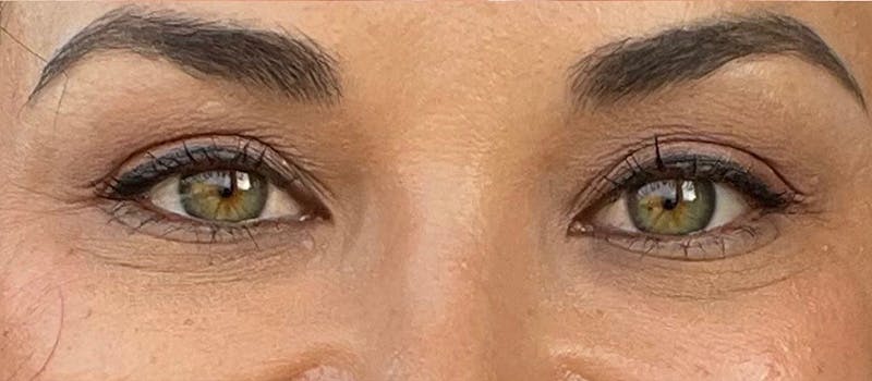 BOTOX Before & After Gallery - Patient 280777 - Image 2