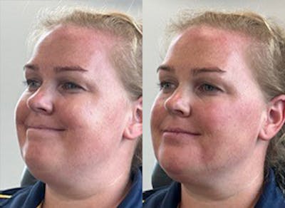 Jawline Filler Before & After Gallery - Patient 315754 - Image 1