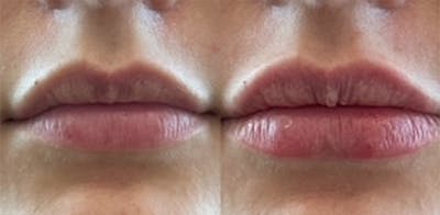 Lip Filler Before & After Gallery - Patient 455459 - Image 1