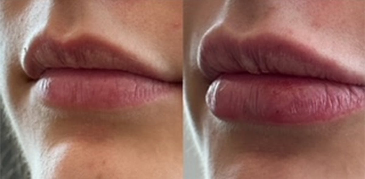 Lip Filler Before & After Gallery - Patient 455459 - Image 2