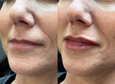 Lip Filler Before & After Gallery - Patient 323042 - Image 1