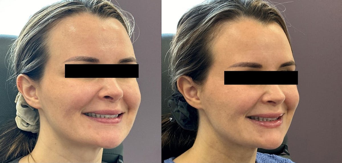 Cheek Filler Before & After Gallery - Patient 267126 - Image 2
